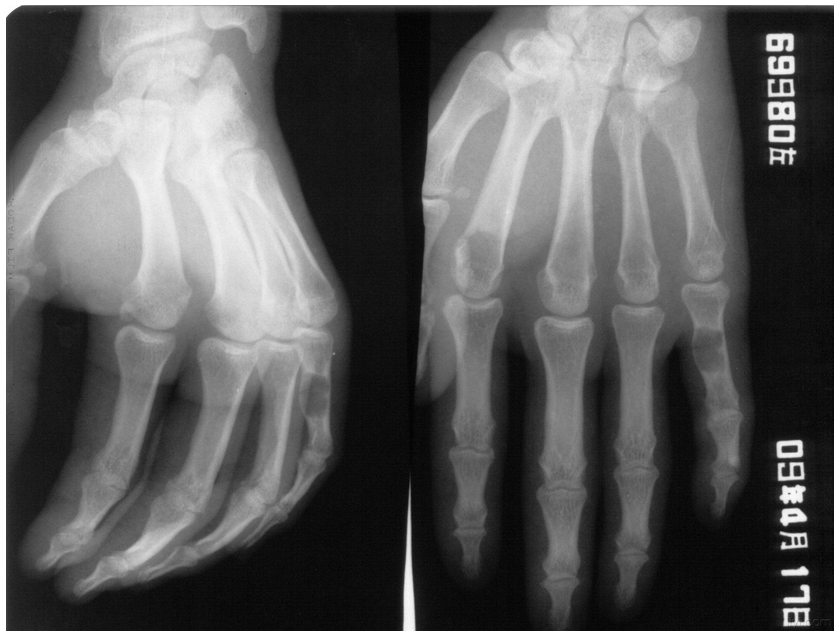 骨外伤患者有哪些康复护理方法?