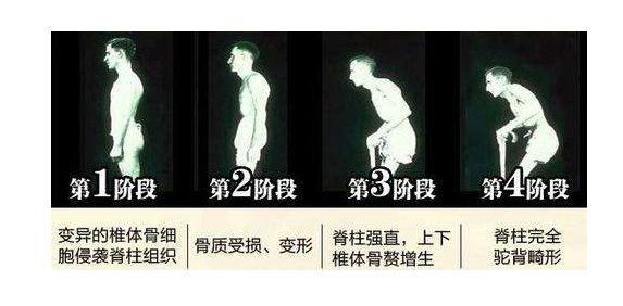 强直性脊柱炎有哪些危害?